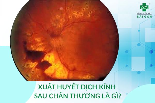 xuất huyết dịch kính do chấn thương