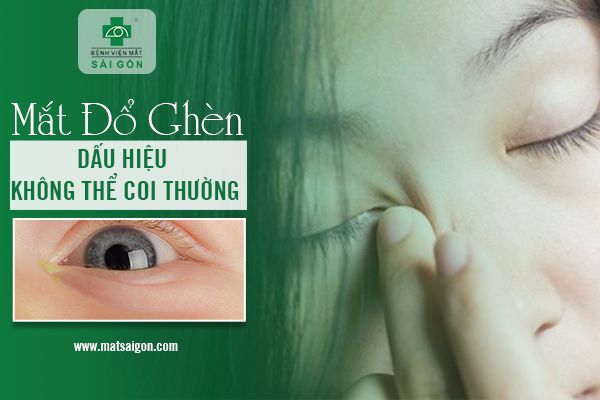 Mắt đổ ghèn dấu hiệu không thể coi thường-1