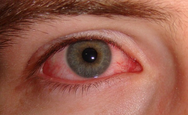 Đỏ mắt: Các nguyên nhân và nguy cơ gây giảm thị lực - Bệnh Viện Mắt Sài Gòn