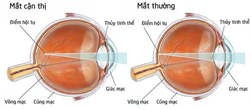 Cận thị nguyên nhân và cách điều trị - Bệnh Viện Mắt Sài Gòn