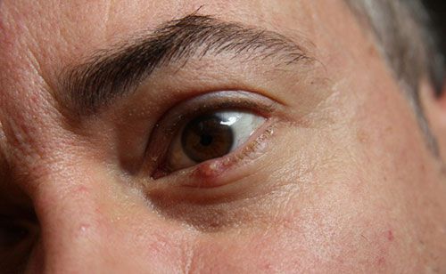  Bị lẹo mắt kiêng gì : Những điều cần biết để làm lành mắt một cách nhanh chóng
