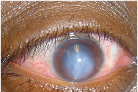Bệnh đau mắt hột nguyên nhân triệu chứng và cách điều trị - Bệnh Viện Mắt Sài Gòn