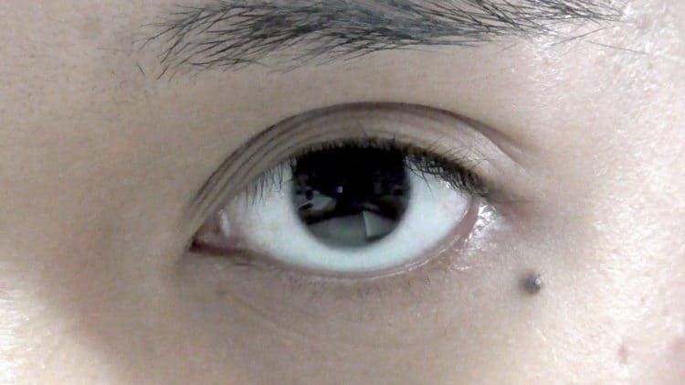 Có những đặc điểm gì đặc biệt về nốt ruồi ở mắt?
