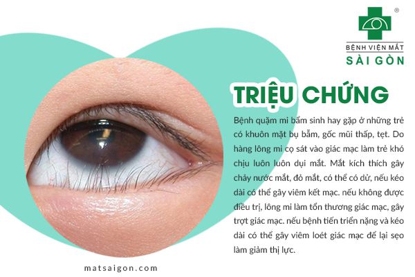 triệu chứng quặm mi bẩm sinh