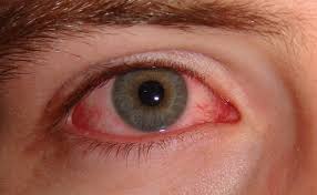 Mỏi mắt và khô mắt có liên quan đến hiện tượng đôi mắt đỏ không?
