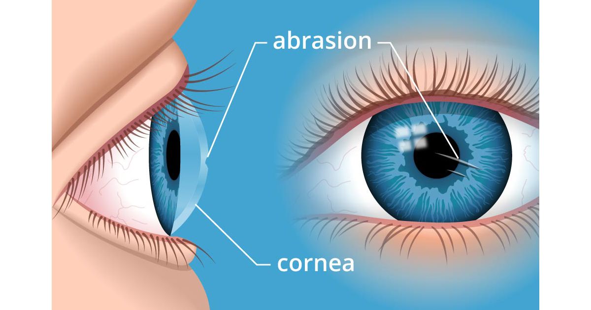 trợt biểu mô giác mạc