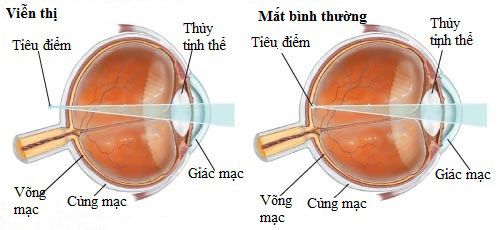 Bệnh Viễn Thị: Hiểu Rõ Nguyên Nhân, Triệu Chứng và Phương Pháp Điều Trị