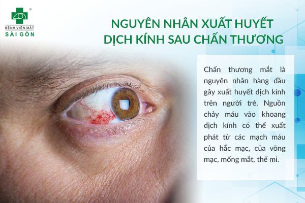 Xuất huyết dịch kính là gì? Khái niệm, nguyên nhân và cách điều trị hiệu quả