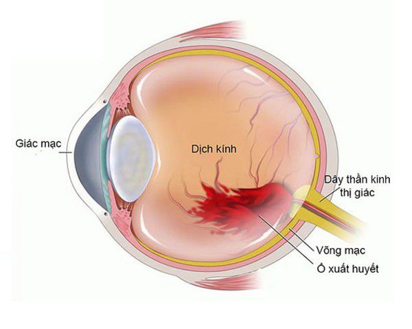 Phương pháp chẩn đoán xuất huyết dịch kính